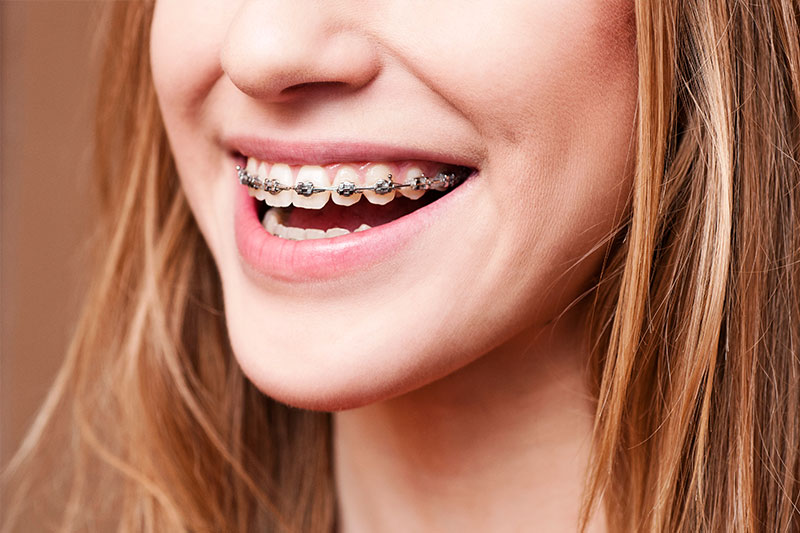 Orthodontics - Dr. Ben Franz, Ketchum Dentist