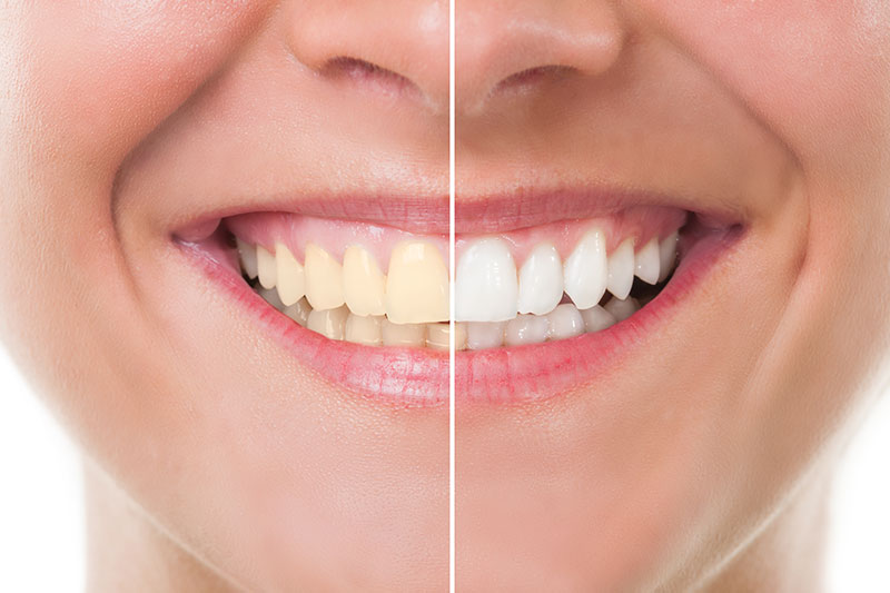 Teeth Whitening - Dr. Ben Franz, Ketchum Dentist